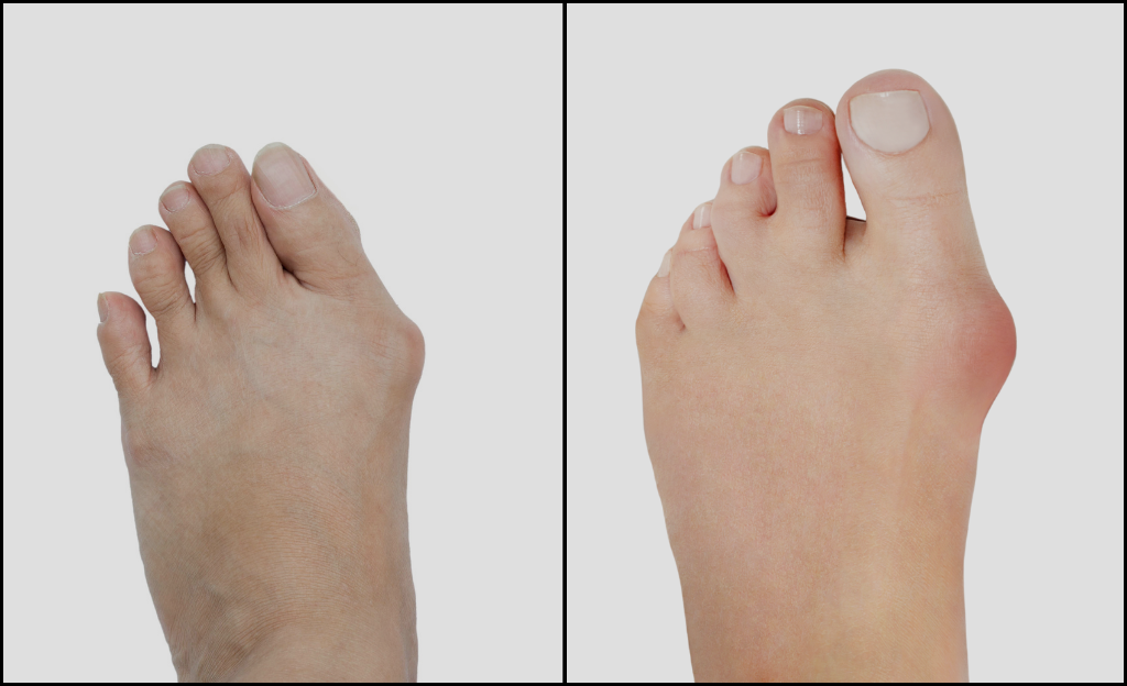 Understanding Bunionette (Tailor’s Bunion) and Dr. Zubeen Mistry’s Expert Care in Plano, TX